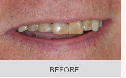Before-Discolored Teeth