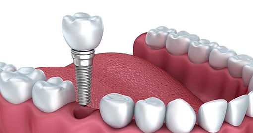 Implant Supported Teeth