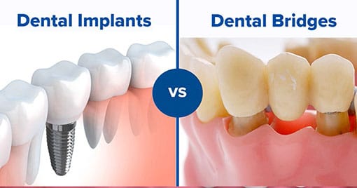 Dental Bridges vs Dental Implants