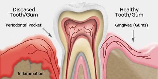 Gum Disease Therapy in Montreal