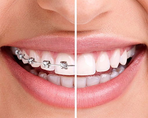 Transparent braces in Gurnee IL, Invisalign dentist