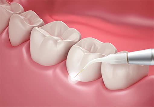 Laser Dental Treatment Montreal