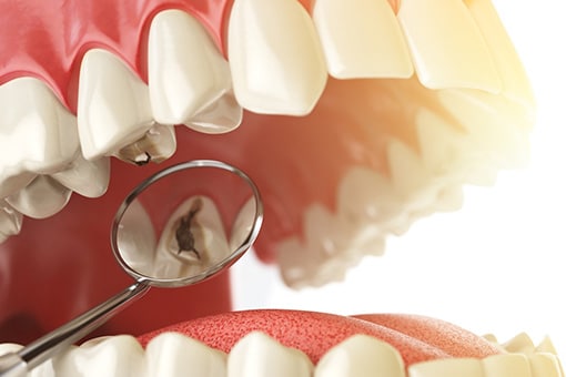 Dental Filling or Dental Crown